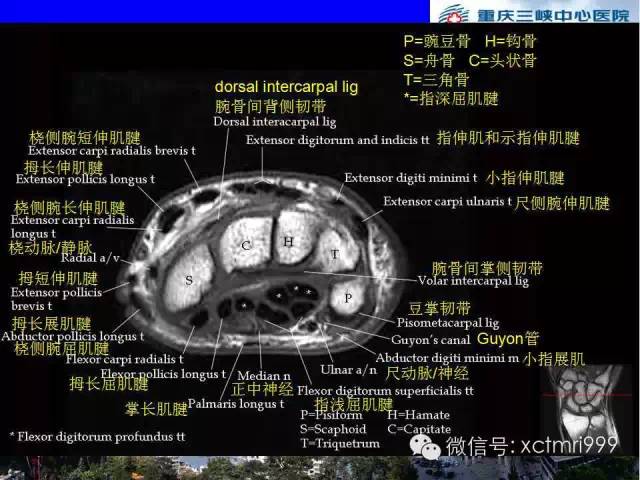 【PPT】腕关节MRI解剖中英对照-42