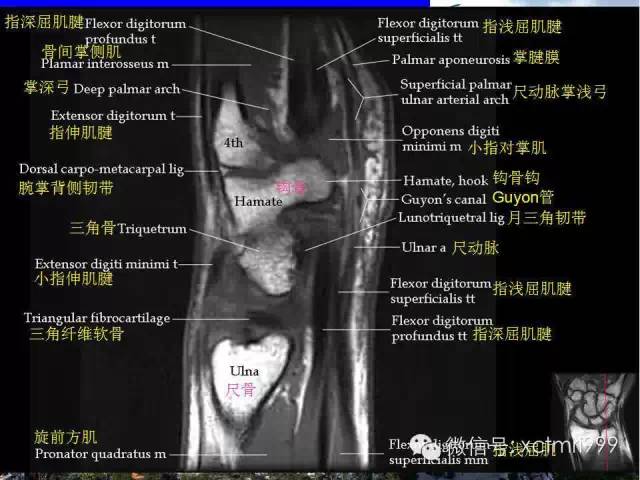 【PPT】腕关节MRI解剖中英对照-19