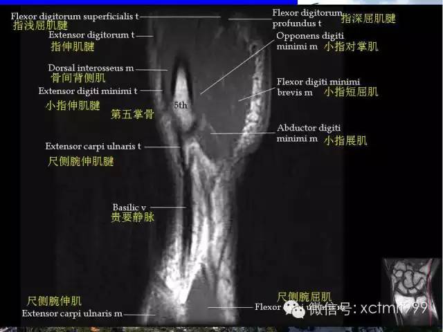 【PPT】腕关节MRI解剖中英对照-15