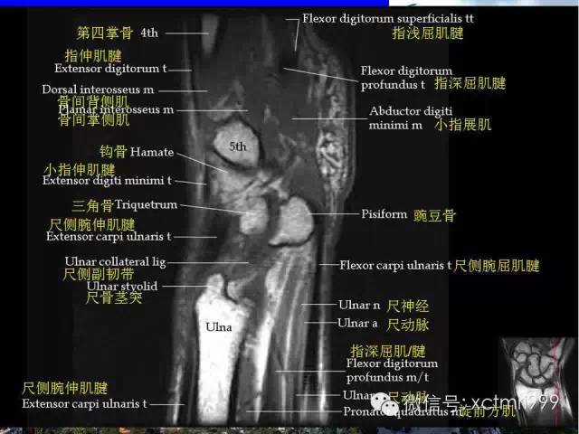 【PPT】腕关节MRI解剖中英对照-17