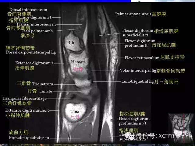 【PPT】腕关节MRI解剖中英对照-20