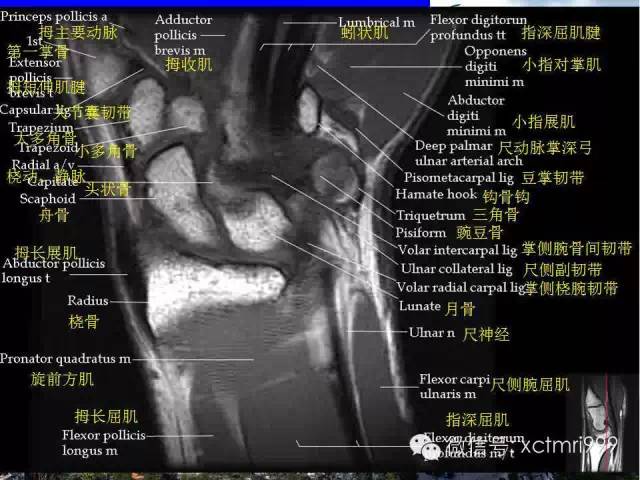 【PPT】腕关节MRI解剖中英对照-8
