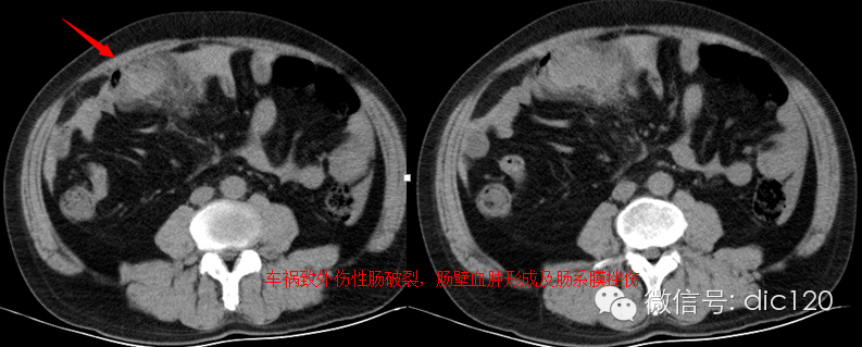 造成肠系膜混浊征的主要疾病鉴别