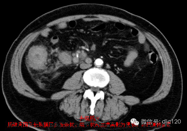 造成肠系膜混浊征的主要疾病鉴别