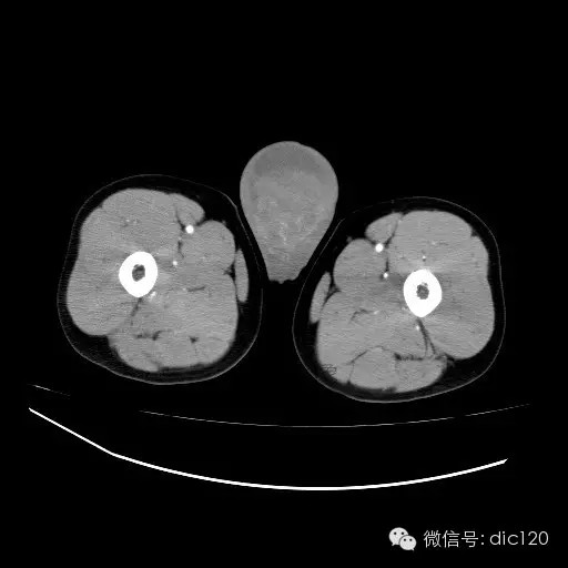 【病例】右侧睾丸精原细胞瘤一例
