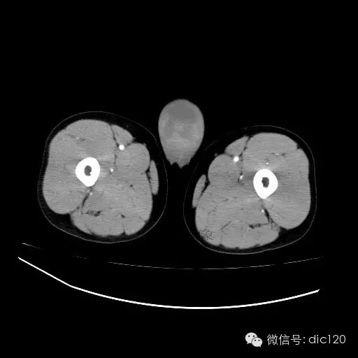 【病例】右侧睾丸精原细胞瘤一例