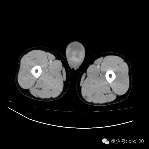 【病例】右侧睾丸精原细胞瘤一例