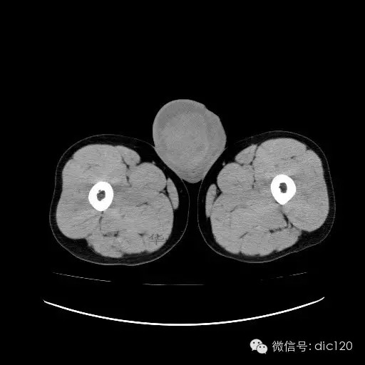 【病例】右侧睾丸精原细胞瘤一例