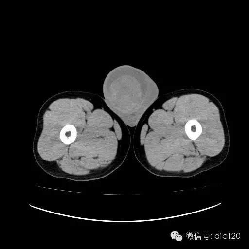 【病例】右侧睾丸精原细胞瘤一例