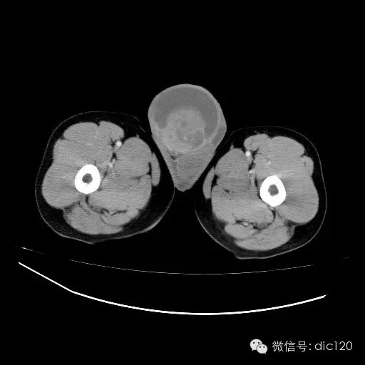 【病例】右侧睾丸精原细胞瘤一例