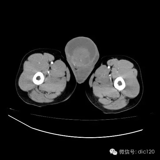 【病例】右侧睾丸精原细胞瘤一例