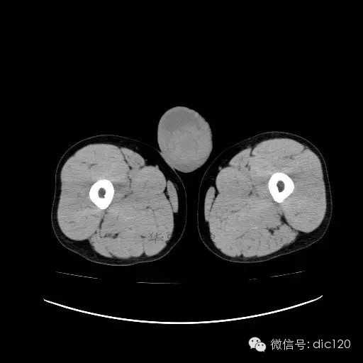 【病例】右侧睾丸精原细胞瘤一例