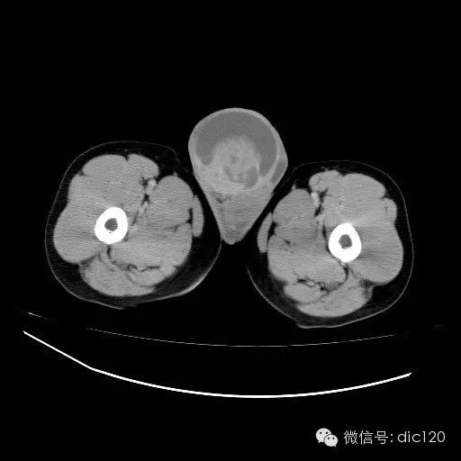 【病例】右侧睾丸精原细胞瘤一例