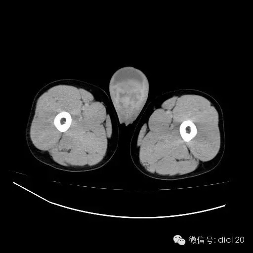 【病例】右侧睾丸精原细胞瘤一例