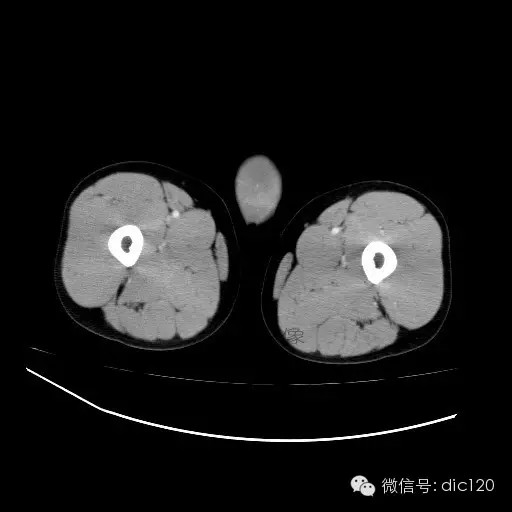 【病例】右侧睾丸精原细胞瘤一例