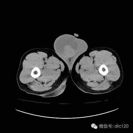 【病例】右侧睾丸精原细胞瘤一例