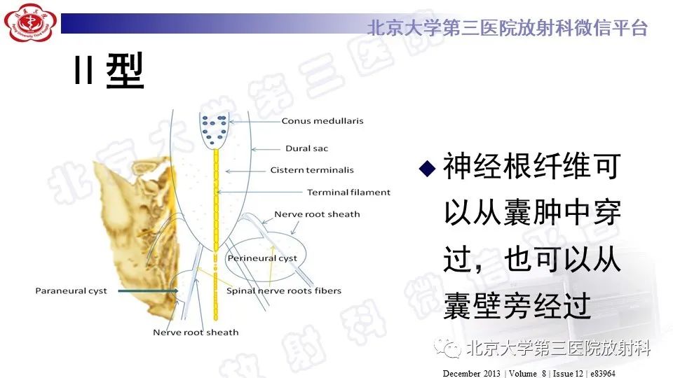 【PPT】椎管内脊膜囊肿-28