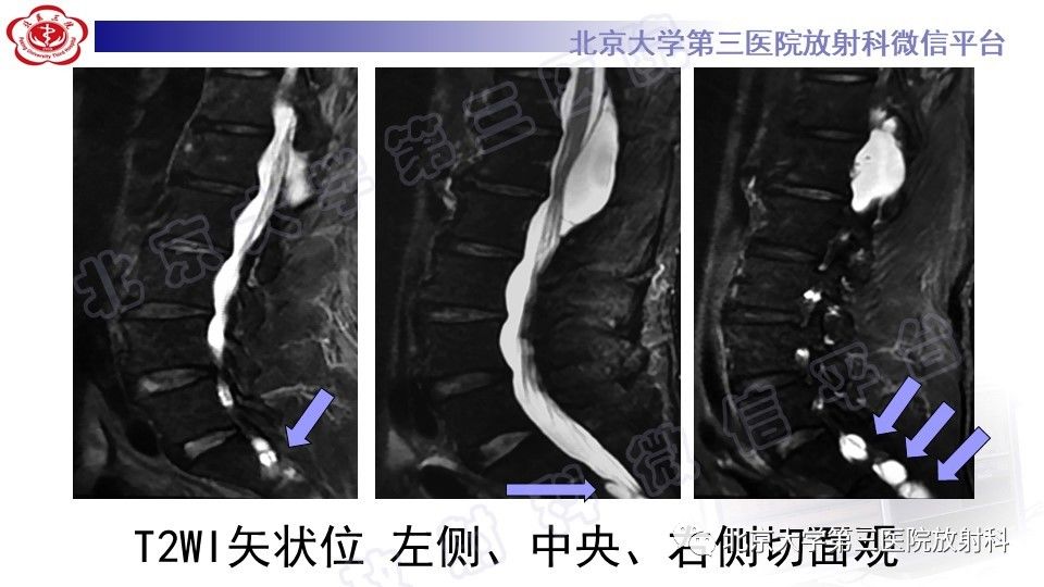 【PPT】椎管内脊膜囊肿-9
