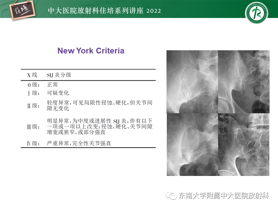 【PPT】脊柱关节炎影像学评估-20