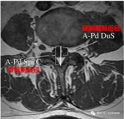 椎管内硬膜外脂肪增多症与终丝脂肪沉积