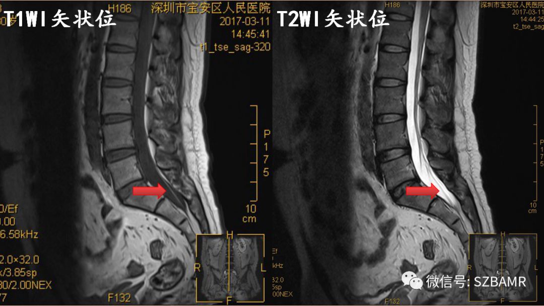 椎管内硬膜外脂肪增多症与终丝脂肪沉积