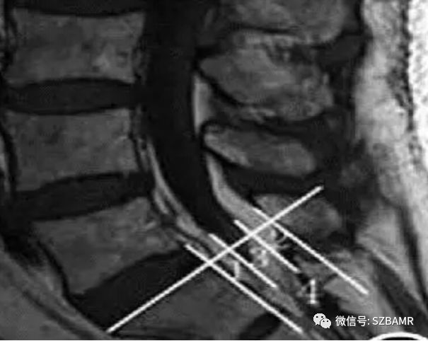 椎管内硬膜外脂肪增多症与终丝脂肪沉积