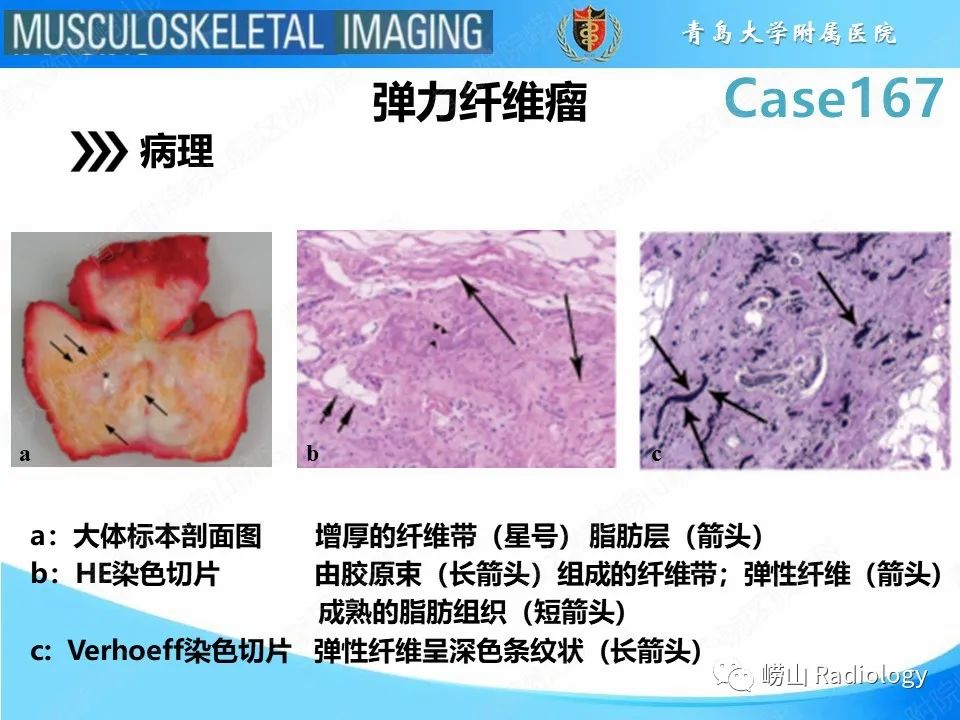 【PPT】背部弹力纤维瘤-13