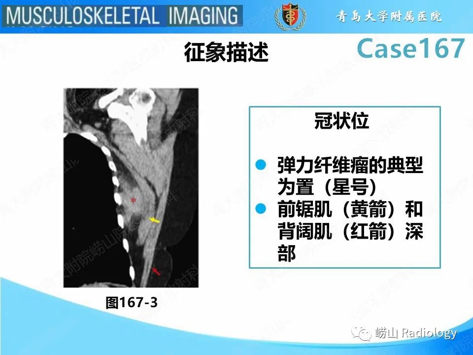 【PPT】背部弹力纤维瘤-19
