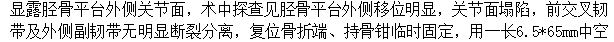 【病例】Segond骨折前交叉韧带损伤1例MR-20