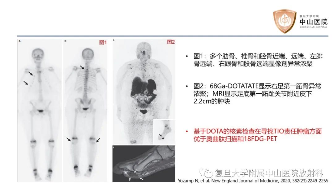【病例】肿瘤相关性骨软化症1例X线CT及MR/PET-CT-23