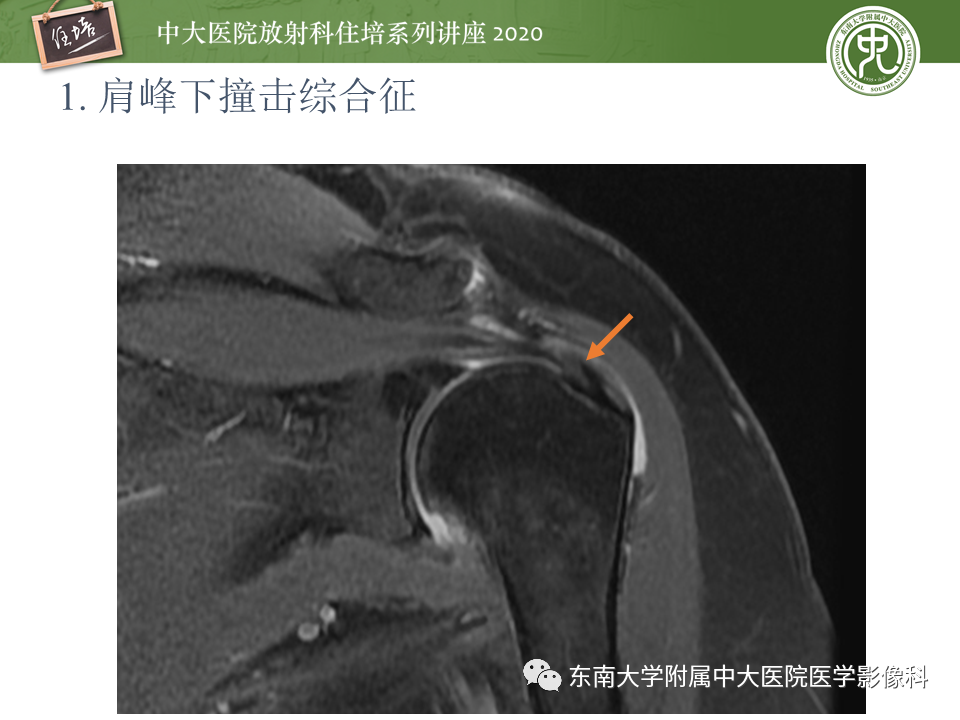 【PPT】常见撞击综合征的影像诊断-10