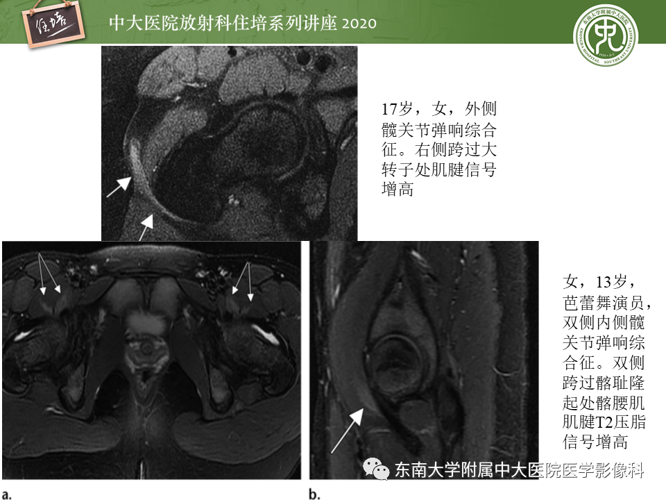 【PPT】常见撞击综合征的影像诊断-45
