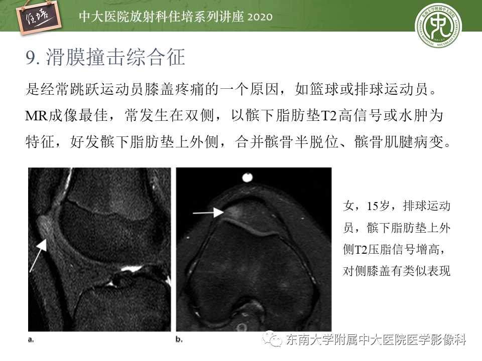 【PPT】常见撞击综合征的影像诊断-48