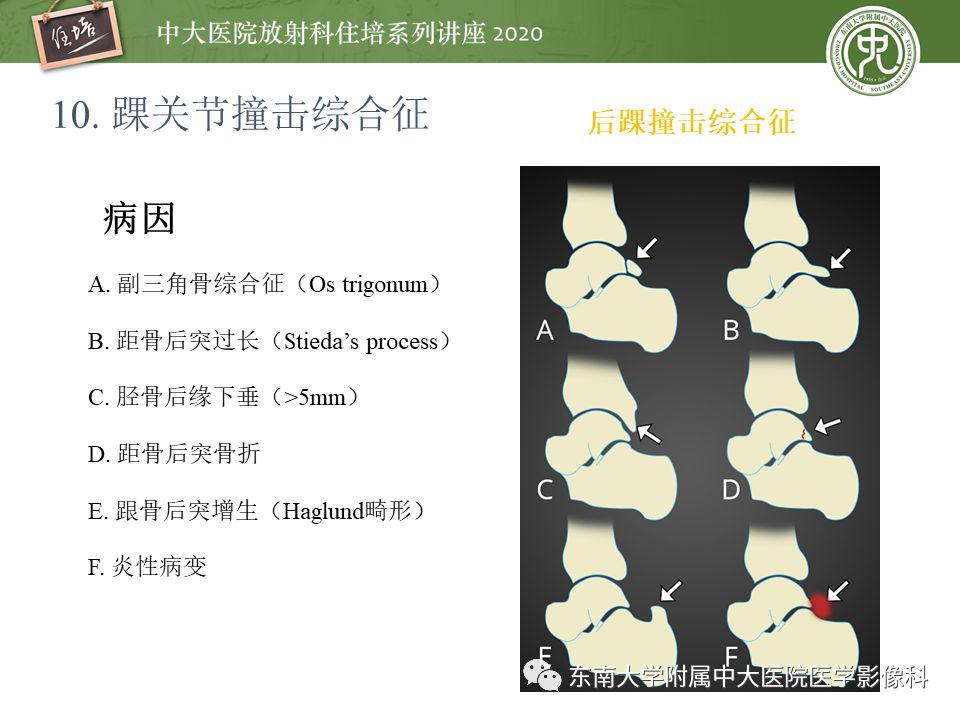 【PPT】常见撞击综合征的影像诊断-61