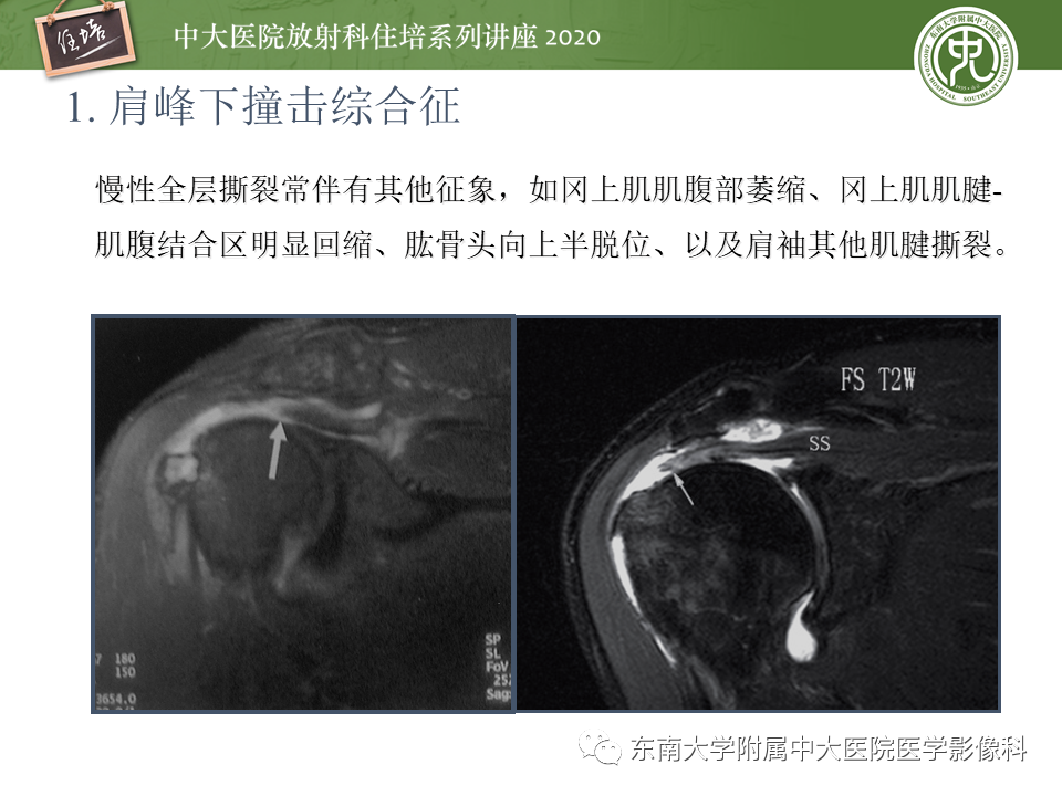 【PPT】常见撞击综合征的影像诊断-12