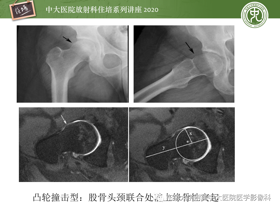 【PPT】常见撞击综合征的影像诊断-34