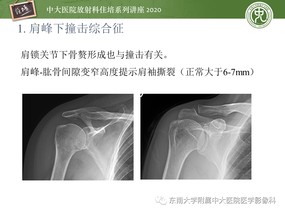 【PPT】常见撞击综合征的影像诊断-7