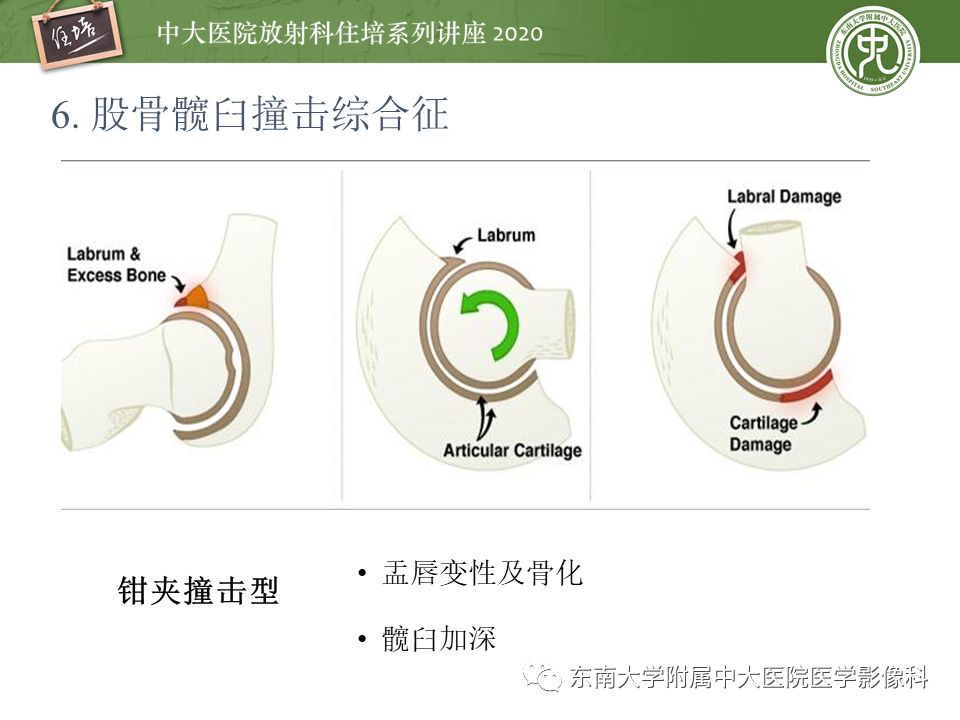【PPT】常见撞击综合征的影像诊断-37