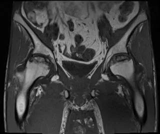 【病例】股骨头缺血性坏死1例X线MR-4