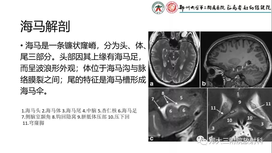 【PPT】海马硬化与癫痫