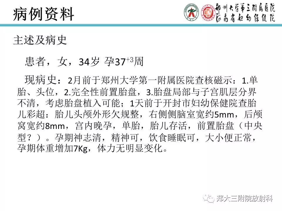 颅缝早闭