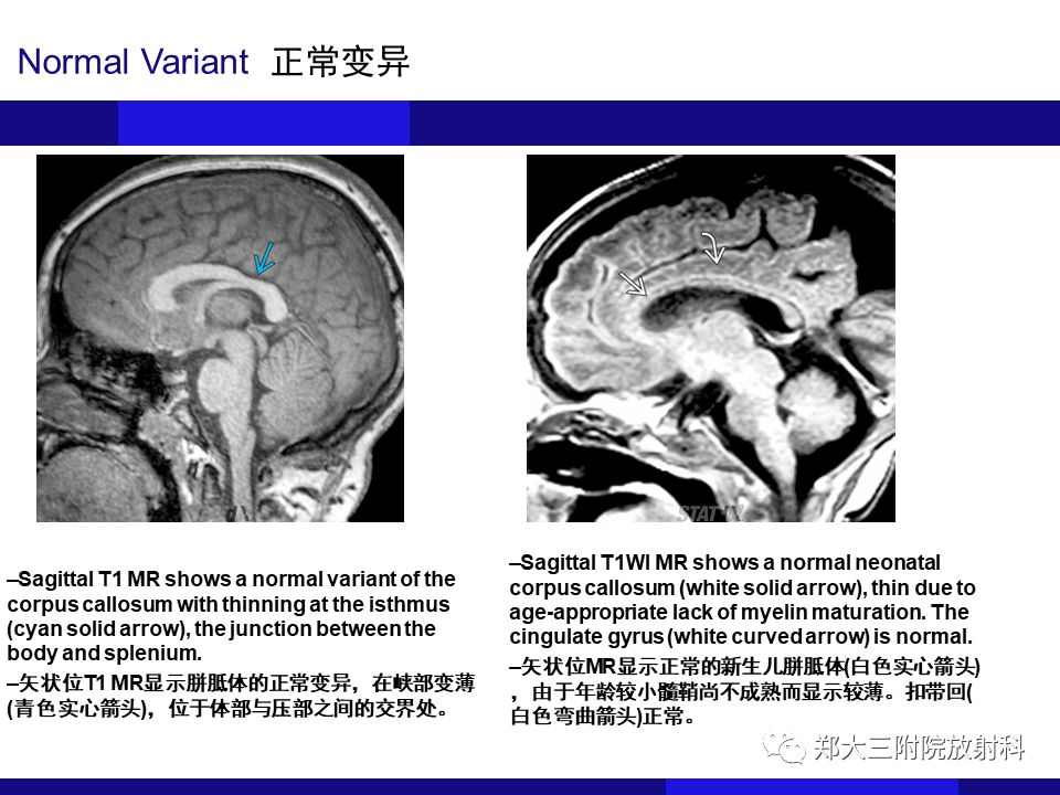 【PPT】胼胝体异常病变的鉴别