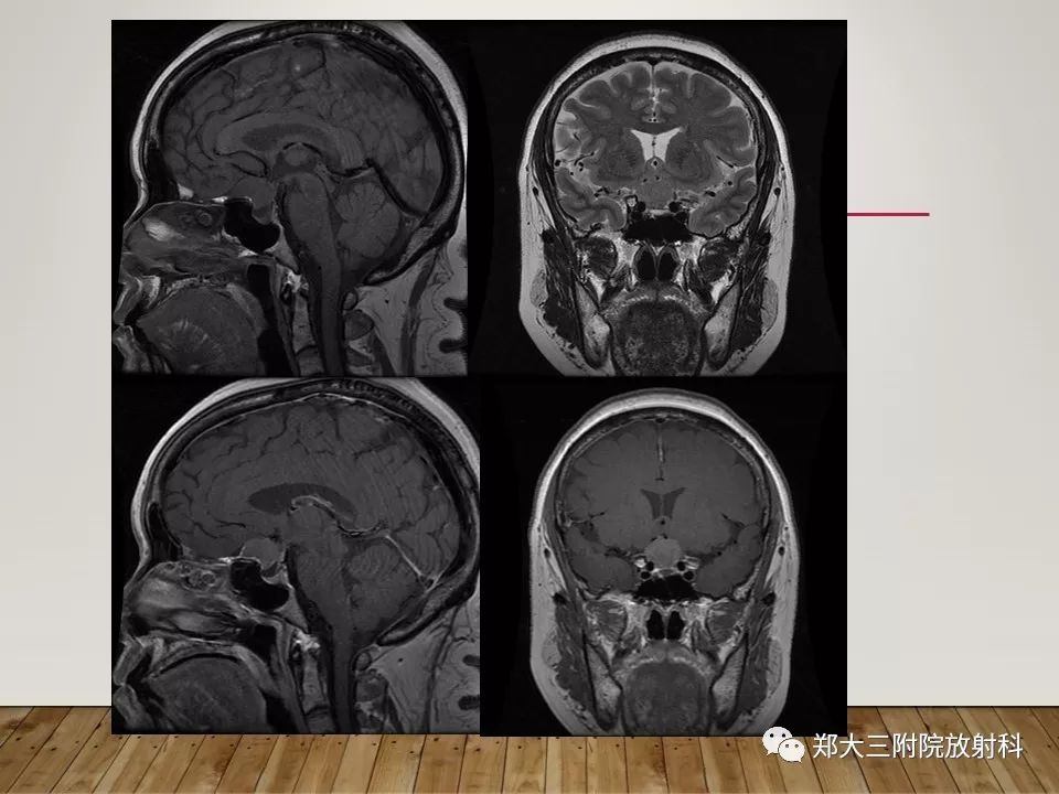 【PPT】灰结节错构瘤的影像诊断