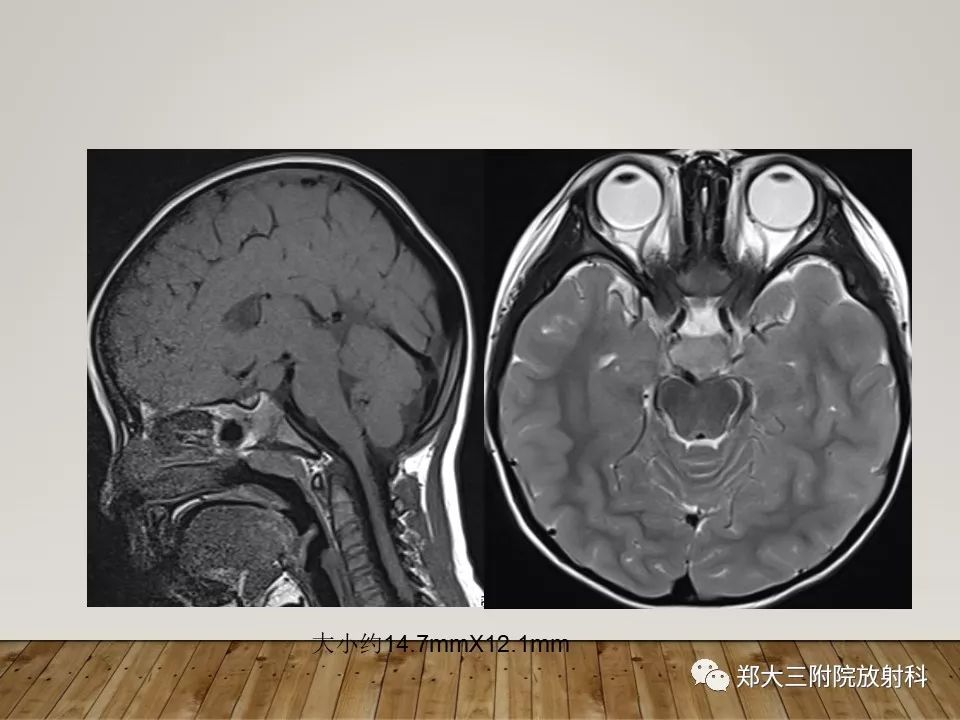 【PPT】灰结节错构瘤的影像诊断