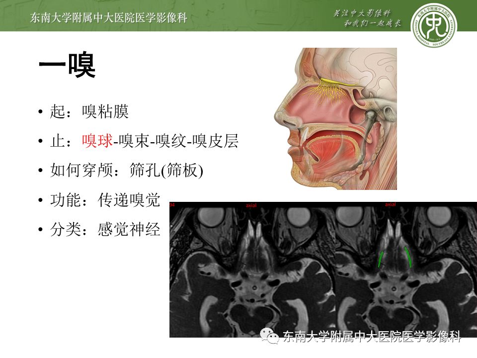 【PPT】颅神经原发肿瘤