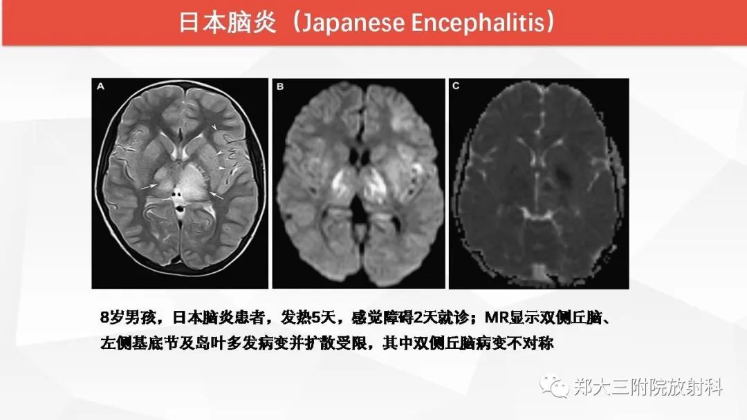 【PPT】Wernicke脑病的影像诊断