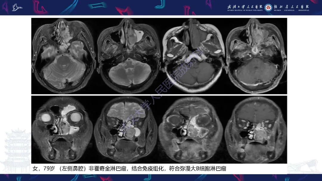 【PPT】鼻腔鼻窦神经内分泌癌影像诊断及鉴别诊断-32