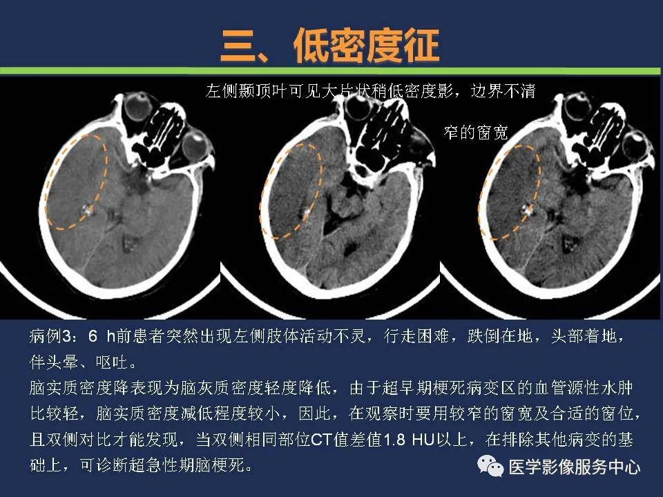【PPT】超早期脑梗死CT征象-29