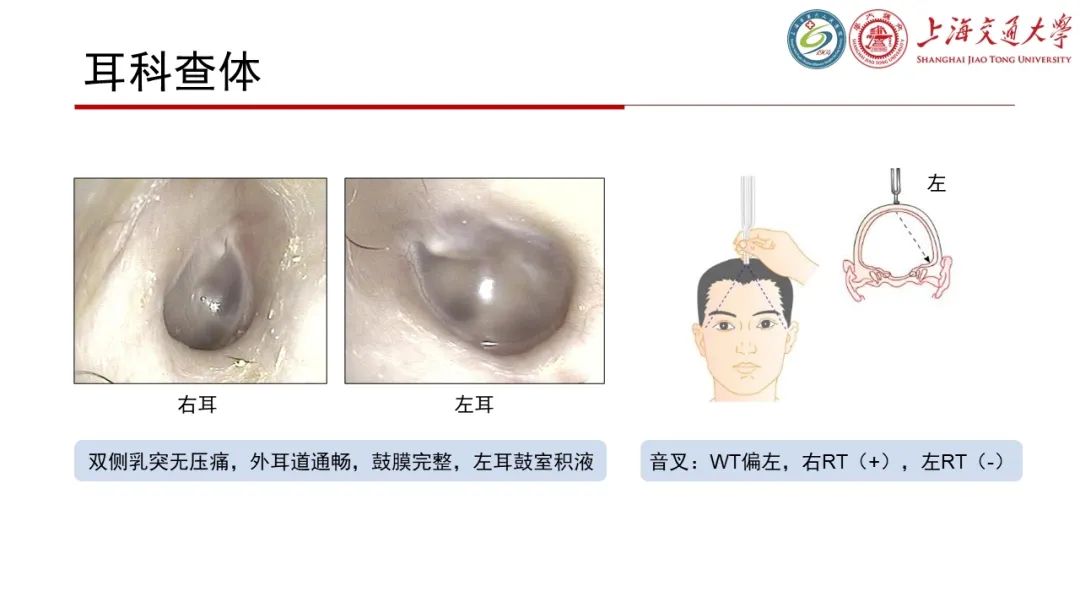 【病例】脑脊液耳漏1例CT及MR病例讨论-3