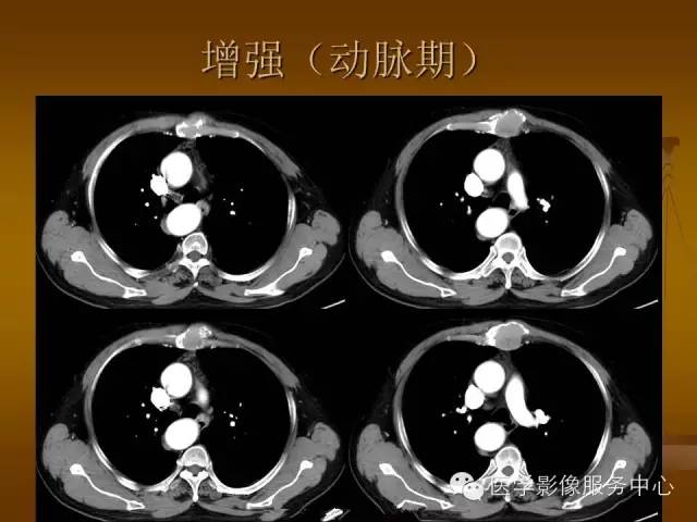 【病例】胸骨浆细胞骨髓瘤1例CT影像表现